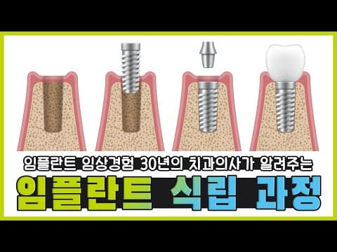 [임플란트 2탄] 임플란트 식립과정